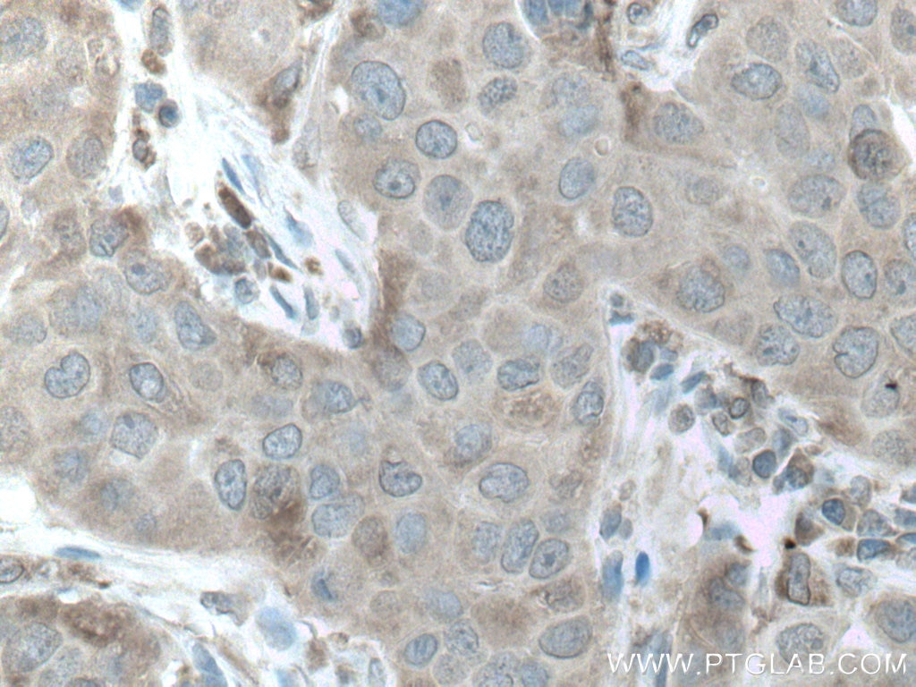 Immunohistochemistry (IHC) staining of human breast cancer tissue using CAMK1 Polyclonal antibody (24312-1-AP)