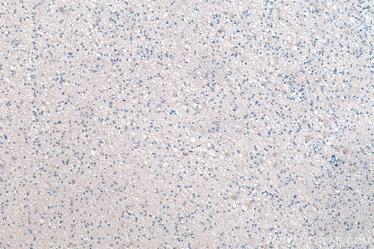 IHC staining of human renal cell carcinoma using 66843-1-Ig