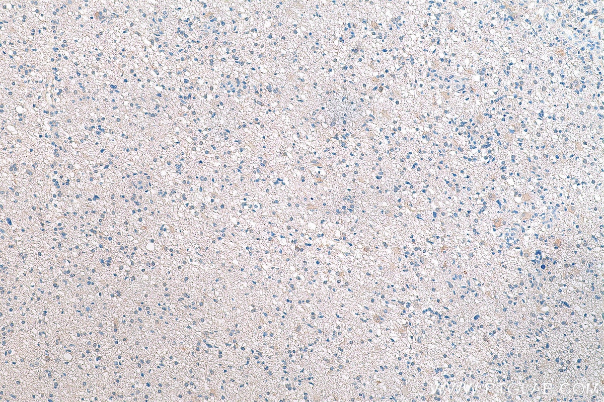 Immunohistochemistry (IHC) staining of human renal cell carcinoma tissue using CAMK2 Monoclonal antibody (66843-1-Ig)