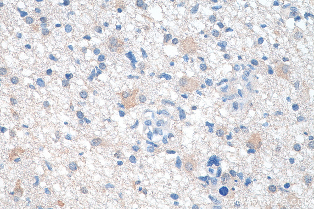 Immunohistochemistry (IHC) staining of human renal cell carcinoma tissue using CaMKII alpha Monoclonal antibody (66843-1-Ig)