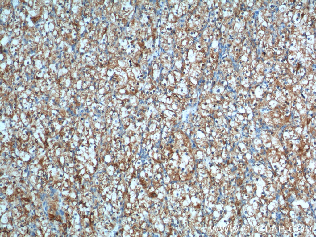 Immunohistochemistry (IHC) staining of human renal cell carcinoma tissue using CAMK2 Polyclonal antibody (13730-1-AP)