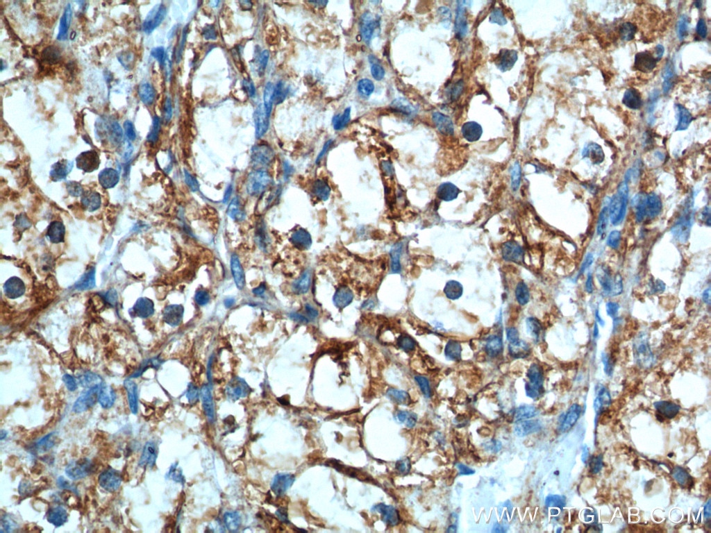 Immunohistochemistry (IHC) staining of human renal cell carcinoma tissue using CAMK2 Polyclonal antibody (13730-1-AP)