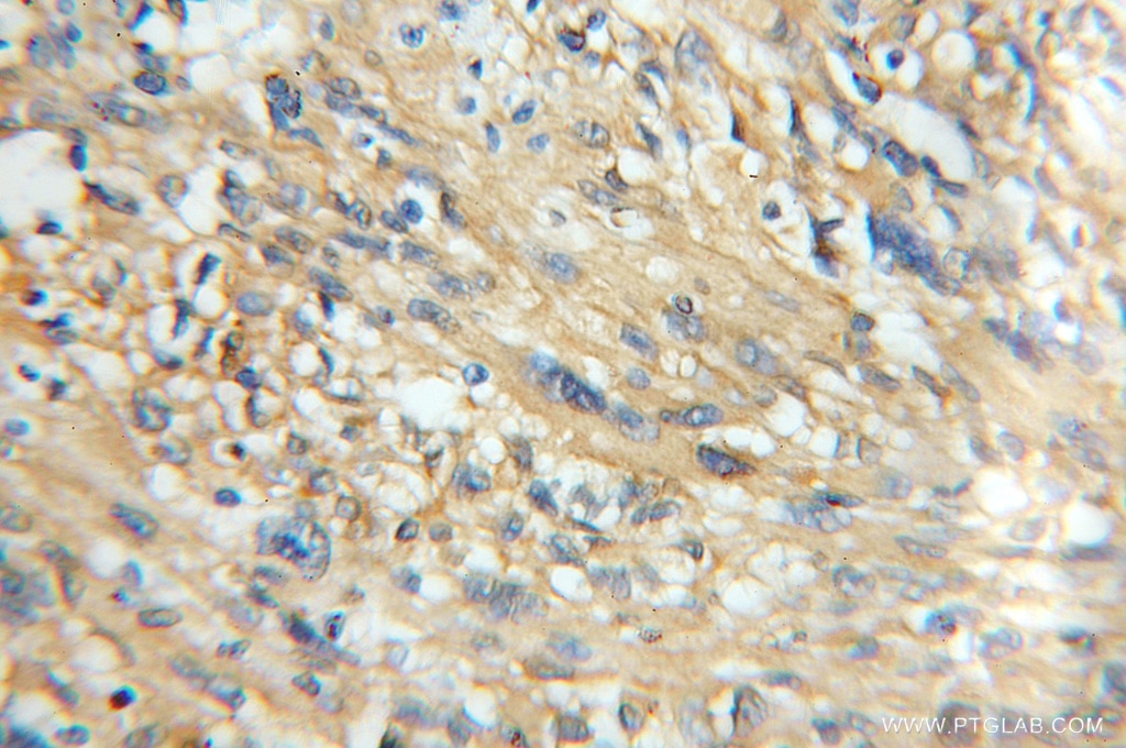 Immunohistochemistry (IHC) staining of human gliomas tissue using CaMKII Beta Polyclonal antibody (11533-1-AP)