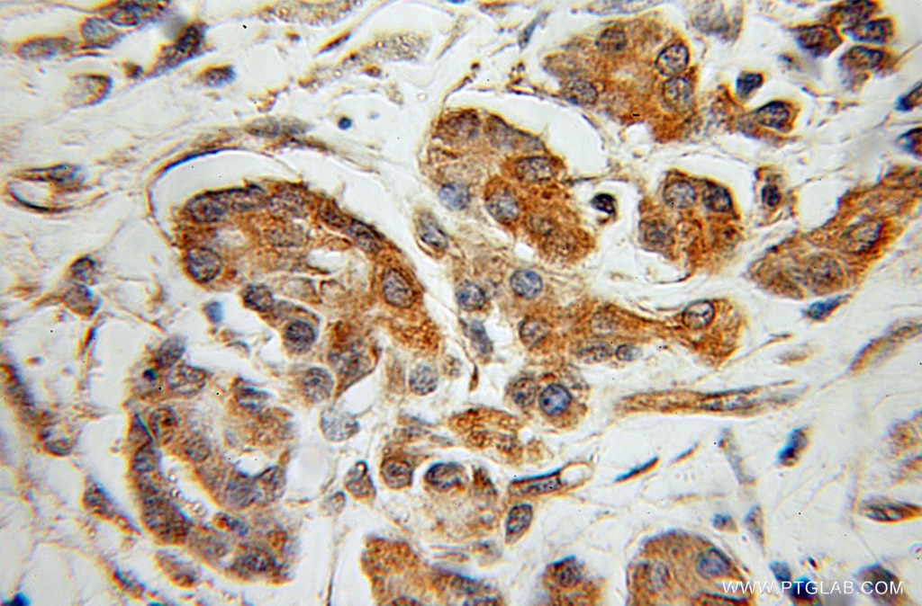 Immunohistochemistry (IHC) staining of human pancreas cancer tissue using CaMKII Gamma Polyclonal antibody (12666-2-AP)