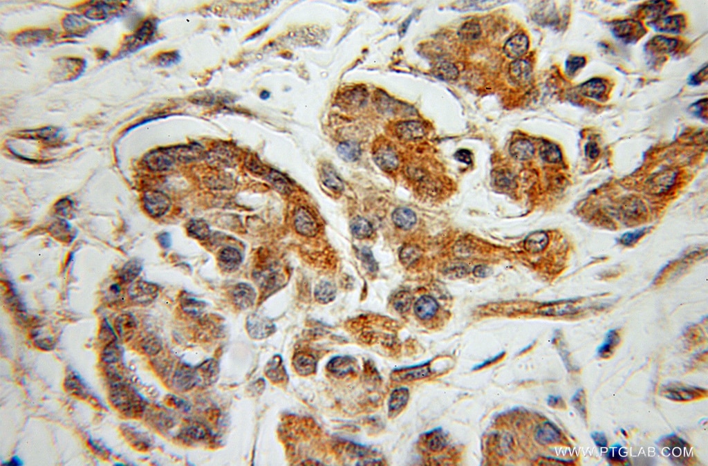 IHC staining of human pancreas cancer using 12666-2-AP