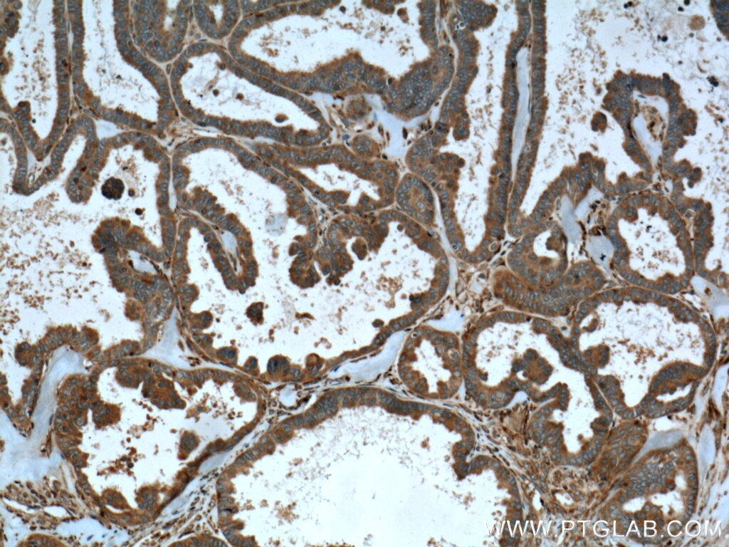 Immunohistochemistry (IHC) staining of human ovary tumor tissue using CaMKIV Polyclonal antibody (13263-1-AP)