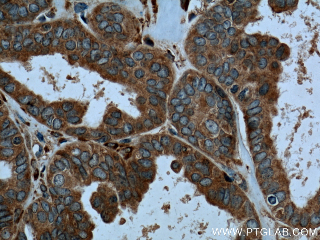 Immunohistochemistry (IHC) staining of human ovary tumor tissue using CaMKIV Polyclonal antibody (13263-1-AP)