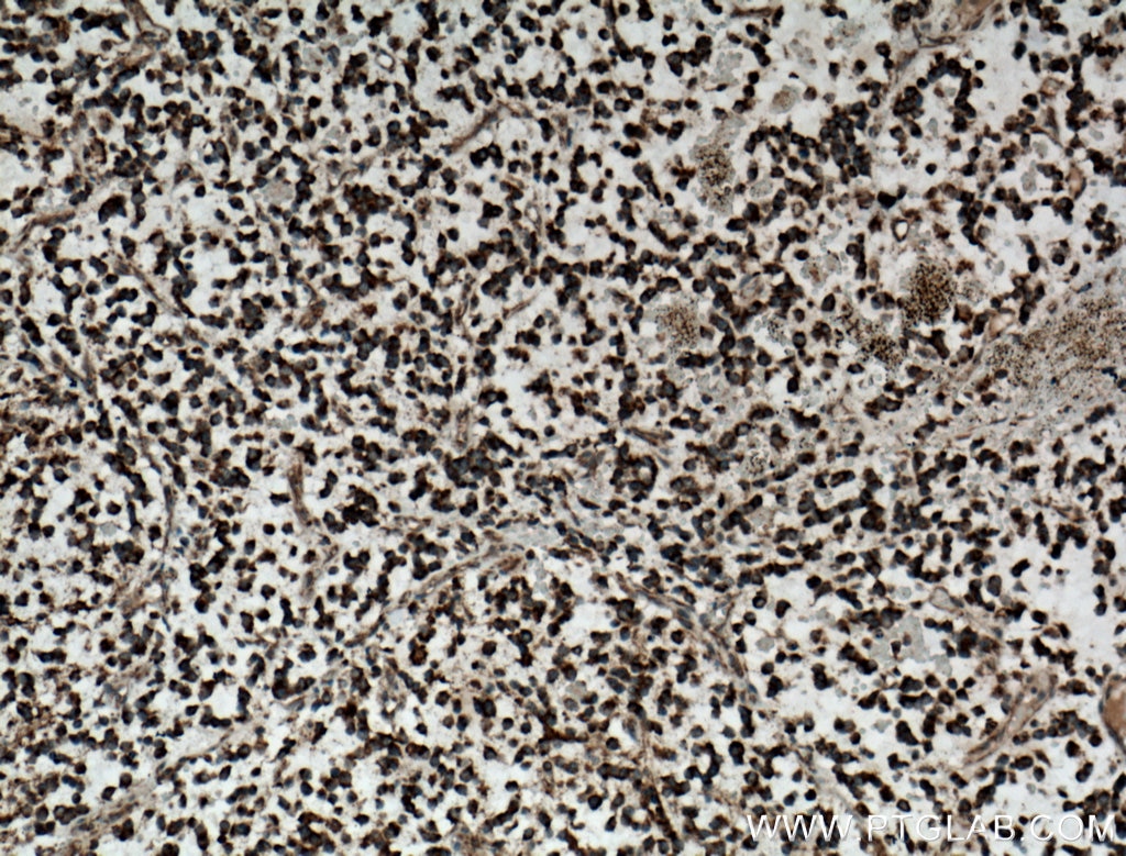 IHC staining of human gliomas using 13624-1-AP