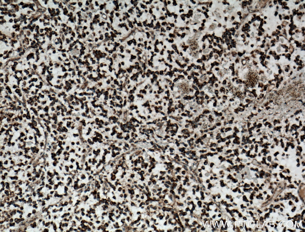 Immunohistochemistry (IHC) staining of human gliomas tissue using CAMKK1 Polyclonal antibody (13624-1-AP)