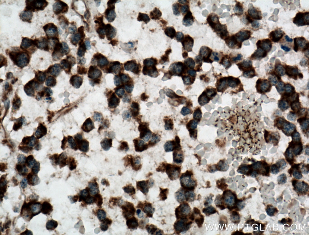 Immunohistochemistry (IHC) staining of human gliomas tissue using CAMKK1 Polyclonal antibody (13624-1-AP)