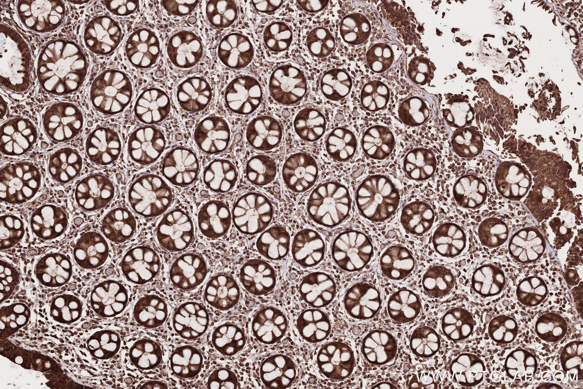 IHC staining of human rectal cancer using 13624-1-AP Immunohistochemistry (IHC) staining of human rectal cancer tissue using CAMKK1 Polyclonal antibody (13624-1-AP)