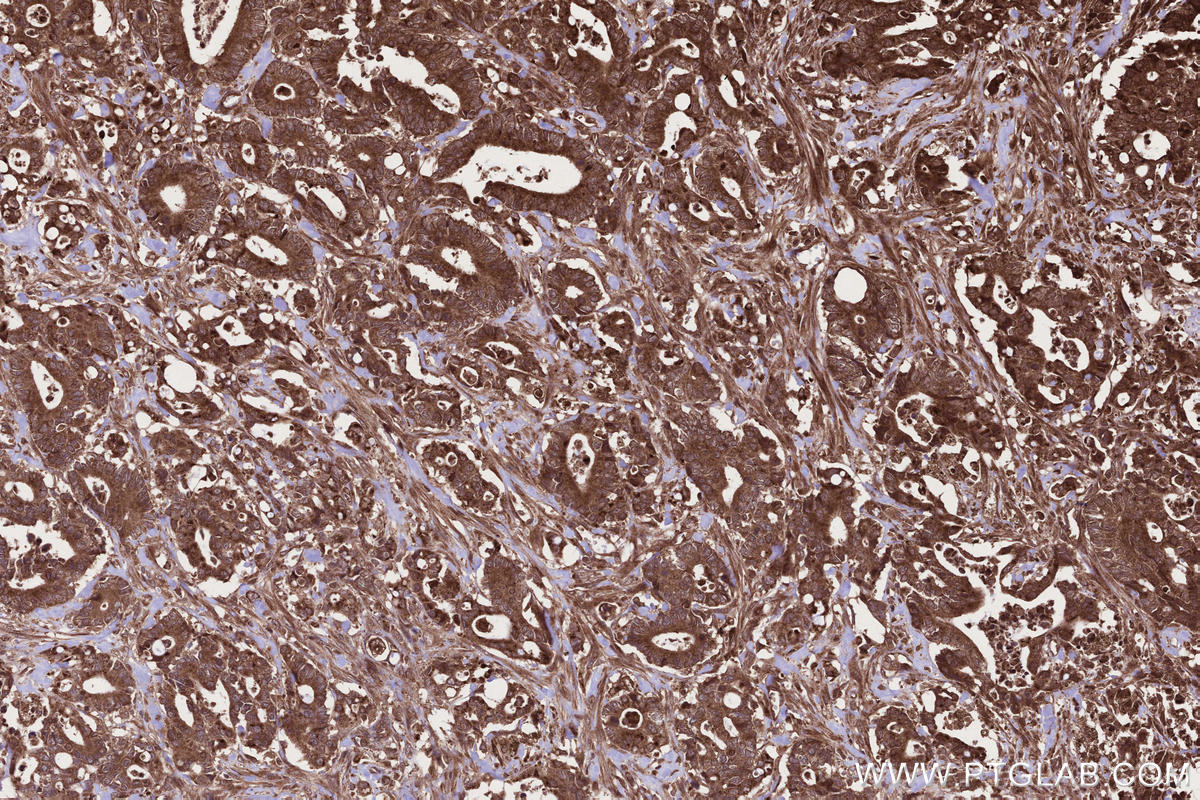 IHC staining of human rectal cancer using 13624-1-AP Immunohistochemistry (IHC) staining of human rectal cancer tissue using CAMKK1 Polyclonal antibody (13624-1-AP)