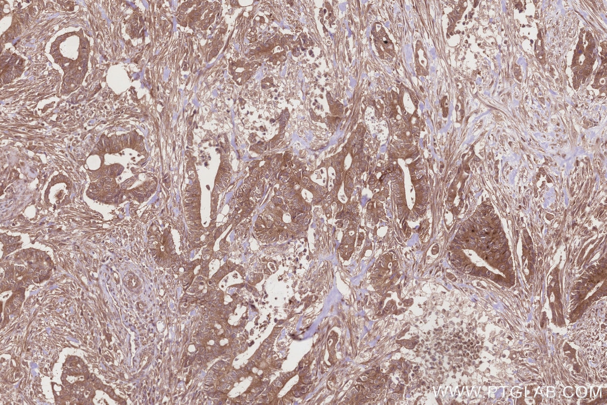 IHC staining of human rectal cancer using 11549-1-AP Immunohistochemistry (IHC) staining of human rectal cancer tissue using CAMKK2 Polyclonal antibody (11549-1-AP)