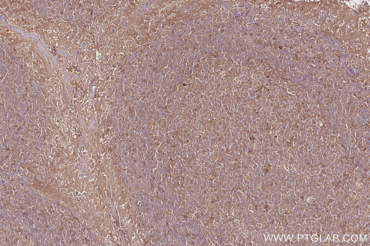 IHC staining of human tonsillitis using 11549-1-AP Immunohistochemistry (IHC) staining of human tonsillitis tissue using CAMKK2 Polyclonal antibody (11549-1-AP)