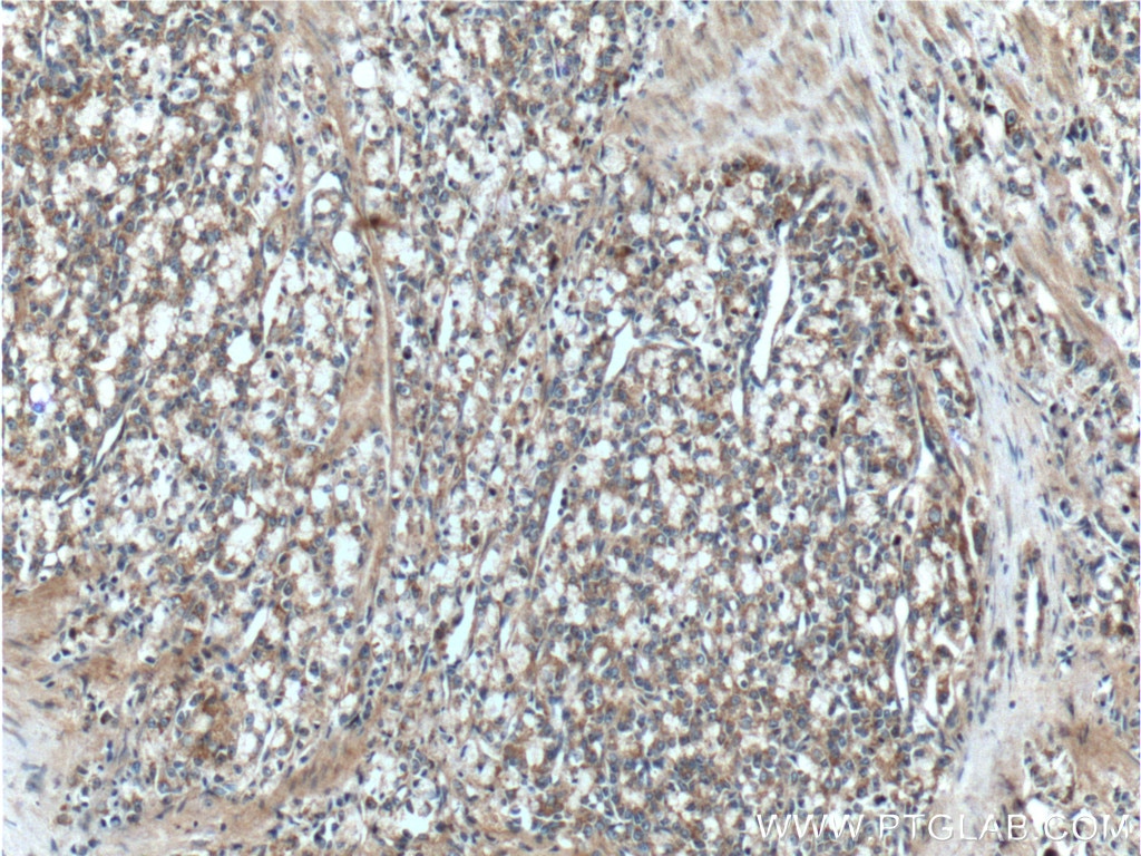 Immunohistochemistry (IHC) staining of human prostate cancer tissue using CAMKK2 Polyclonal antibody (11549-1-AP)