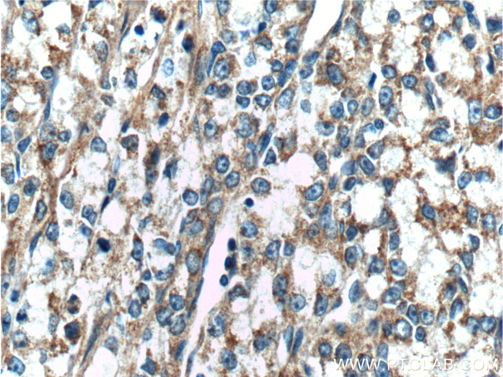 Immunohistochemistry (IHC) staining of human prostate cancer tissue using CAMKK2 Polyclonal antibody (11549-1-AP)