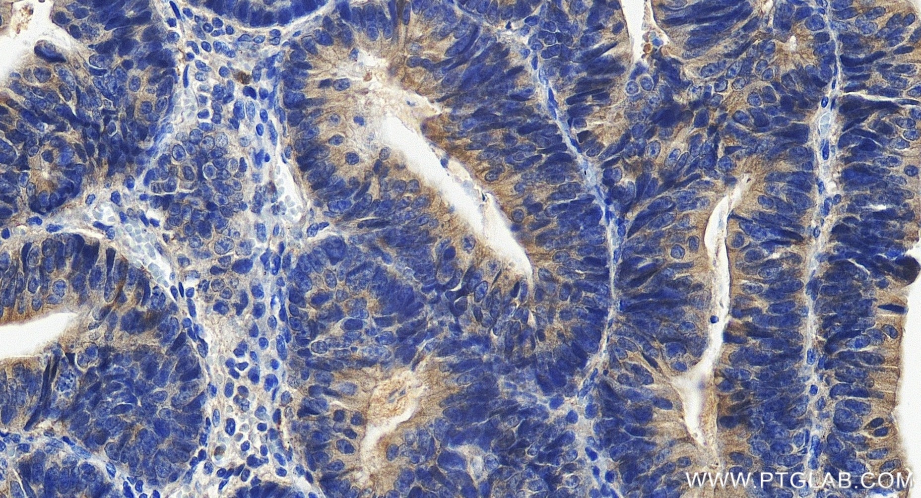 Immunohistochemistry (IHC) staining of human colon cancer tissue using CAMKK2 Recombinant monoclonal antibody (82720-14-RR)