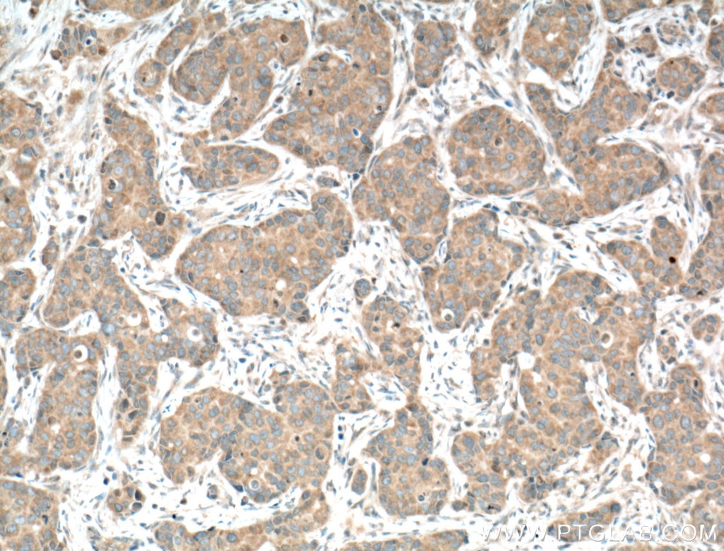 Immunohistochemistry (IHC) staining of human breast cancer tissue using CAMLG Polyclonal antibody (23327-1-AP)