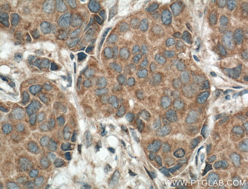 Immunohistochemistry (IHC) staining of human breast cancer tissue using CAMLG Polyclonal antibody (23327-1-AP)