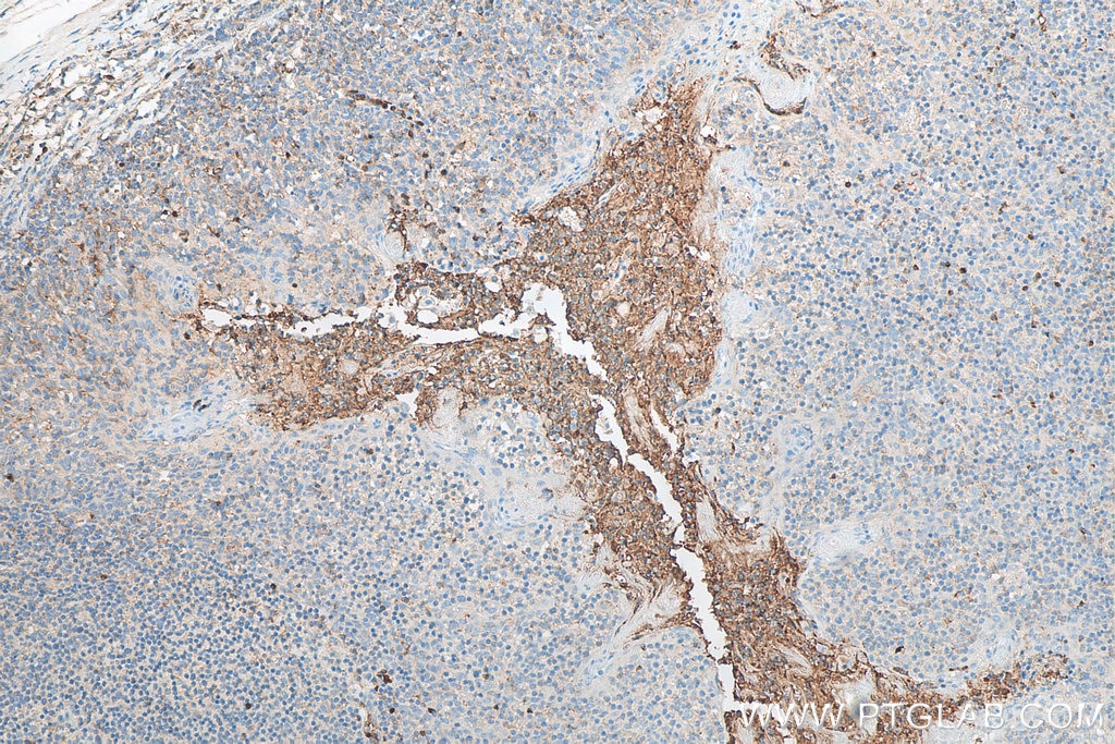 Immunohistochemistry (IHC) staining of human tonsillitis tissue using CAMP Polyclonal antibody (12009-1-AP)