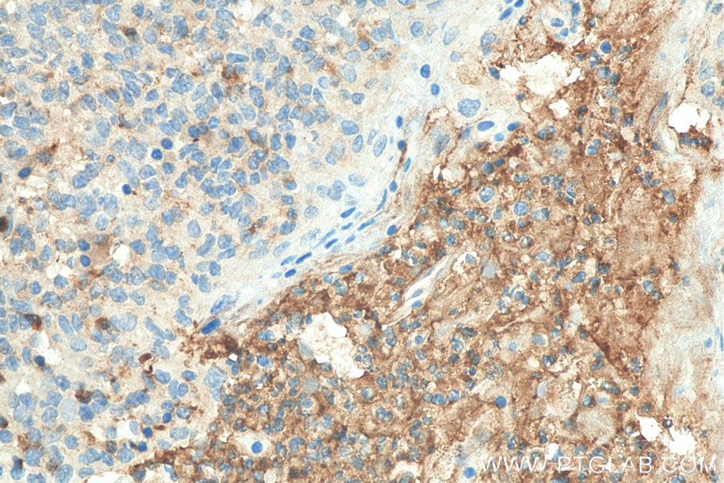 Immunohistochemistry (IHC) staining of human tonsillitis tissue using CAMP Polyclonal antibody (12009-1-AP)
