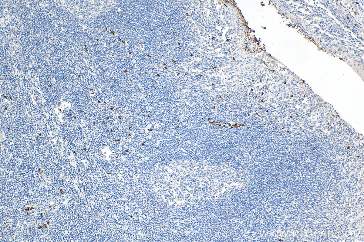 Immunohistochemistry (IHC) staining of human tonsillitis tissue using CAMP Polyclonal antibody (12009-1-AP)