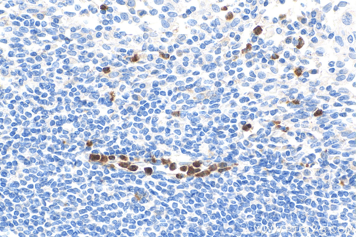 Immunohistochemistry (IHC) staining of human tonsillitis tissue using CAMP Polyclonal antibody (12009-1-AP)