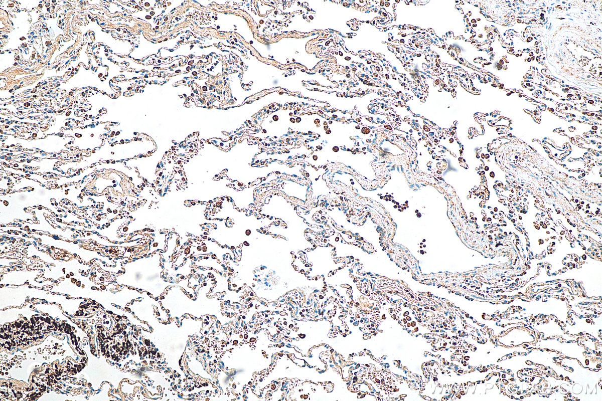 Immunohistochemistry (IHC) staining of human lung cancer tissue using CAMP Polyclonal antibody (12009-1-AP)