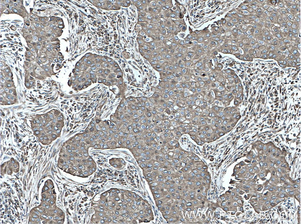Immunohistochemistry (IHC) staining of human breast cancer tissue using Calnexin Polyclonal antibody (10427-2-AP)