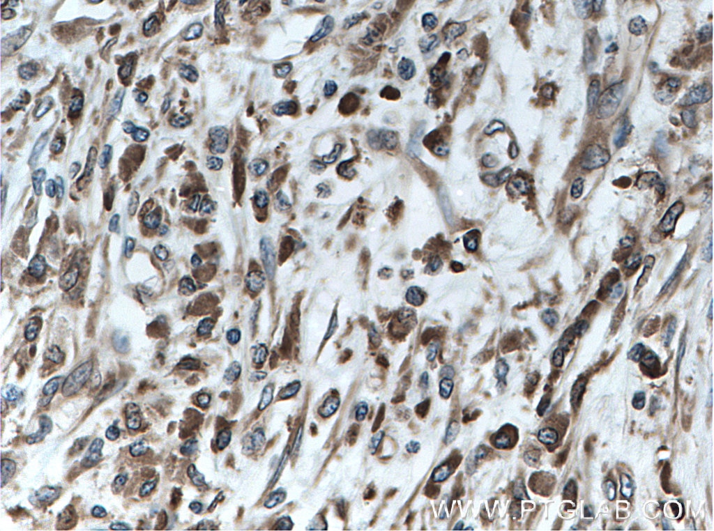 Immunohistochemistry (IHC) staining of human breast cancer tissue using Calnexin Polyclonal antibody (10427-2-AP)
