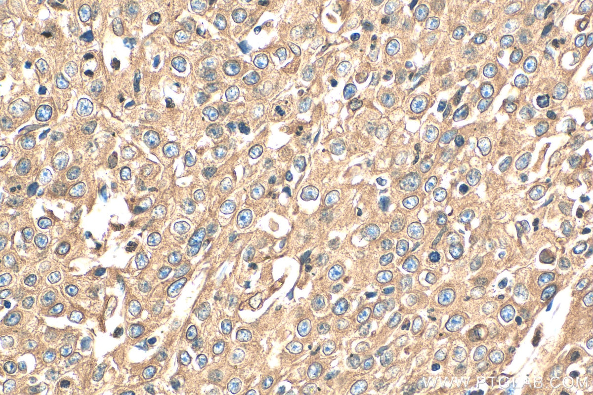 Immunohistochemistry (IHC) staining of human cervical cancer tissue using Calnexin Polyclonal antibody (10427-2-AP)
