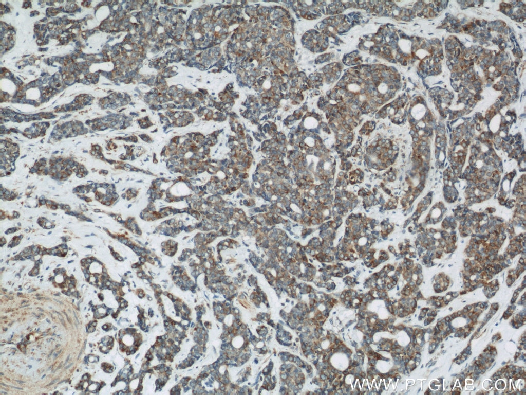 Immunohistochemistry (IHC) staining of human cervical cancer tissue using Calnexin Polyclonal antibody (10427-2-AP)