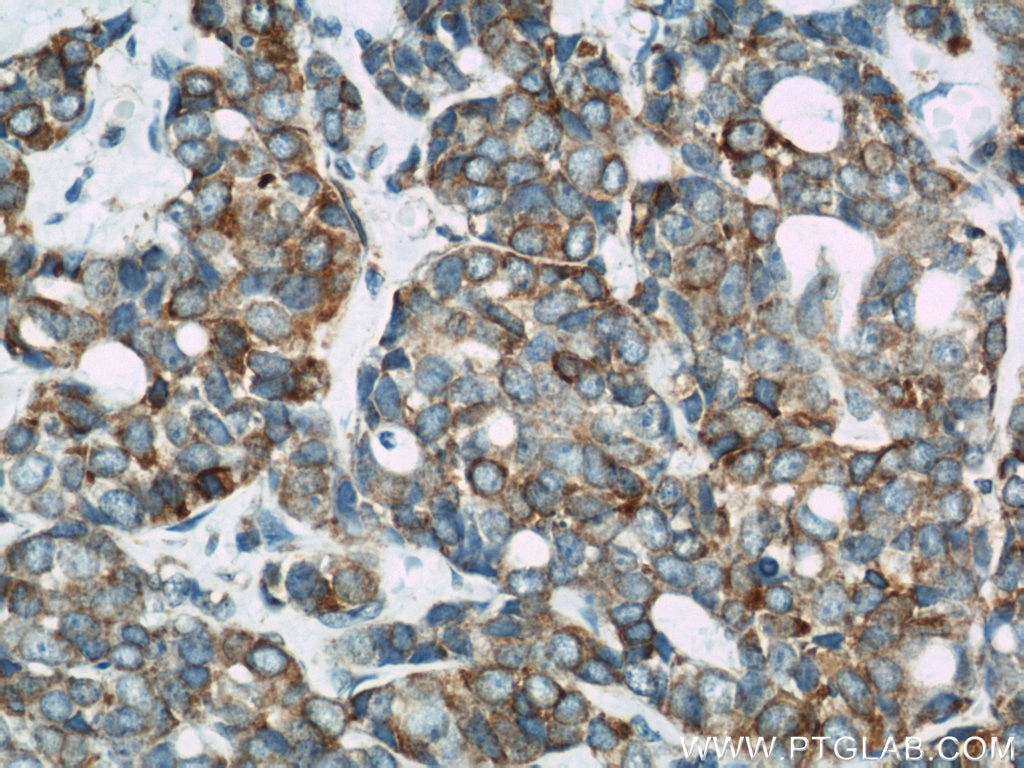 Immunohistochemistry (IHC) staining of human cervical cancer tissue using Calnexin Polyclonal antibody (10427-2-AP)