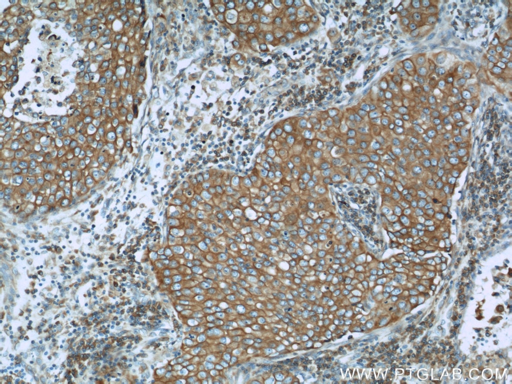 Immunohistochemistry (IHC) staining of human breast cancer tissue using Calnexin Polyclonal antibody (10427-2-AP)