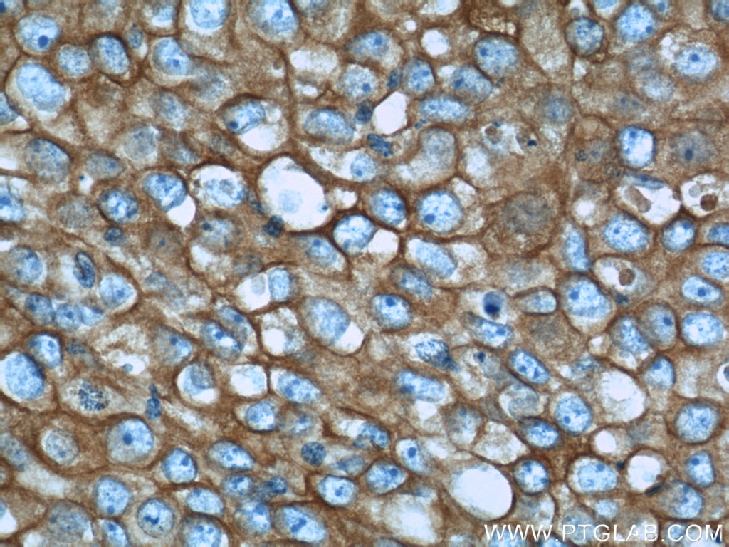 Immunohistochemistry (IHC) staining of human breast cancer tissue using Calnexin Polyclonal antibody (10427-2-AP)