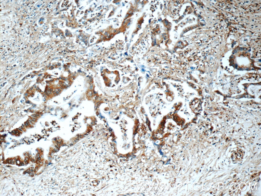Immunohistochemistry (IHC) staining of human pancreas cancer tissue using CAP1 Polyclonal antibody (16231-1-AP)