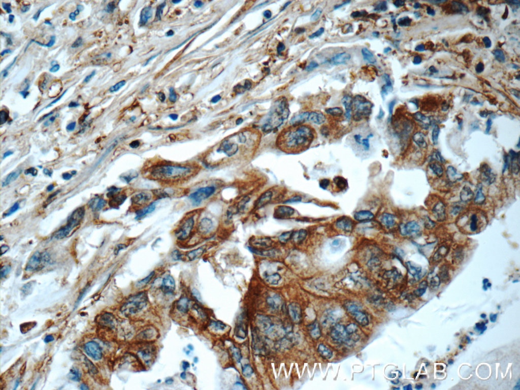 IHC staining of human pancreas cancer using 16231-1-AP