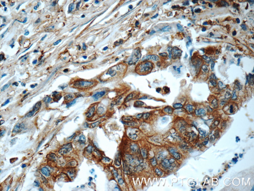 Immunohistochemistry (IHC) staining of human pancreas cancer tissue using CAP1 Polyclonal antibody (16231-1-AP)