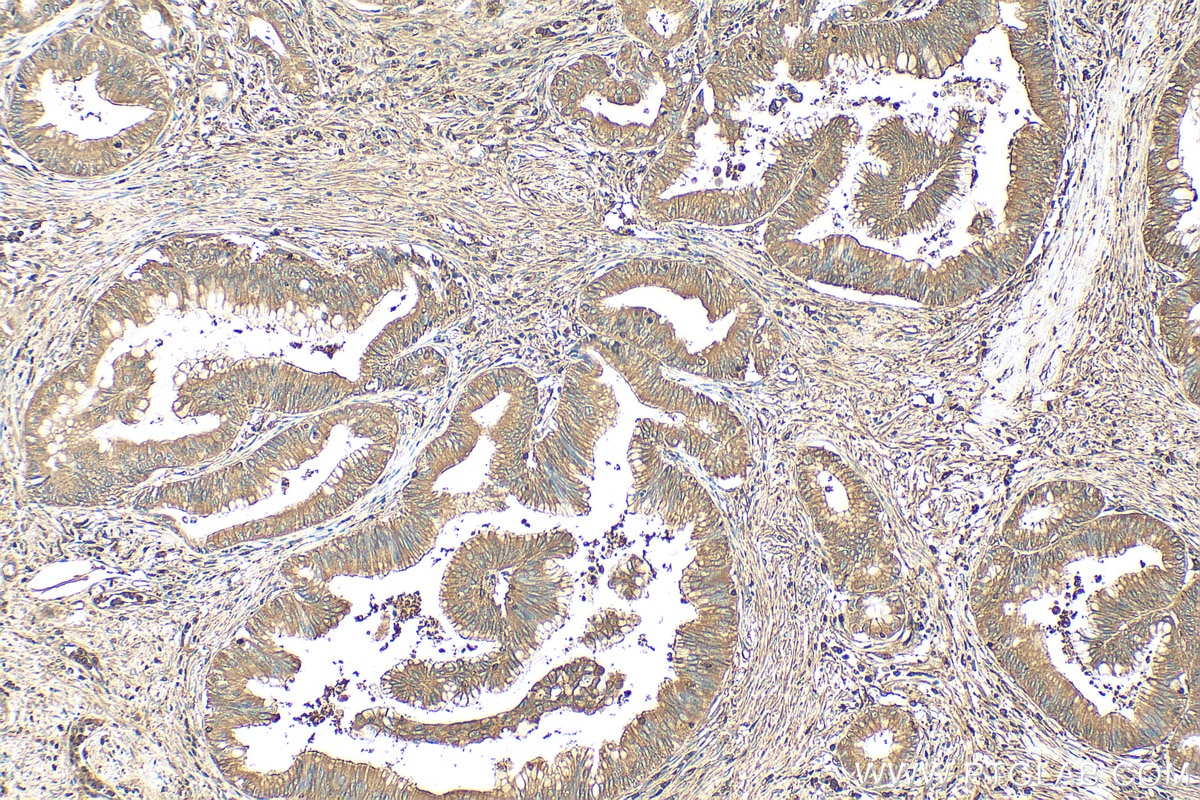 Immunohistochemistry (IHC) staining of human pancreas cancer tissue using CAP1 Polyclonal antibody (16231-1-AP)