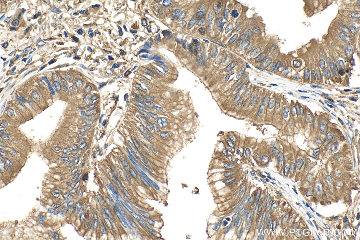 Immunohistochemistry (IHC) staining of human pancreas cancer tissue using CAP1 Polyclonal antibody (16231-1-AP)