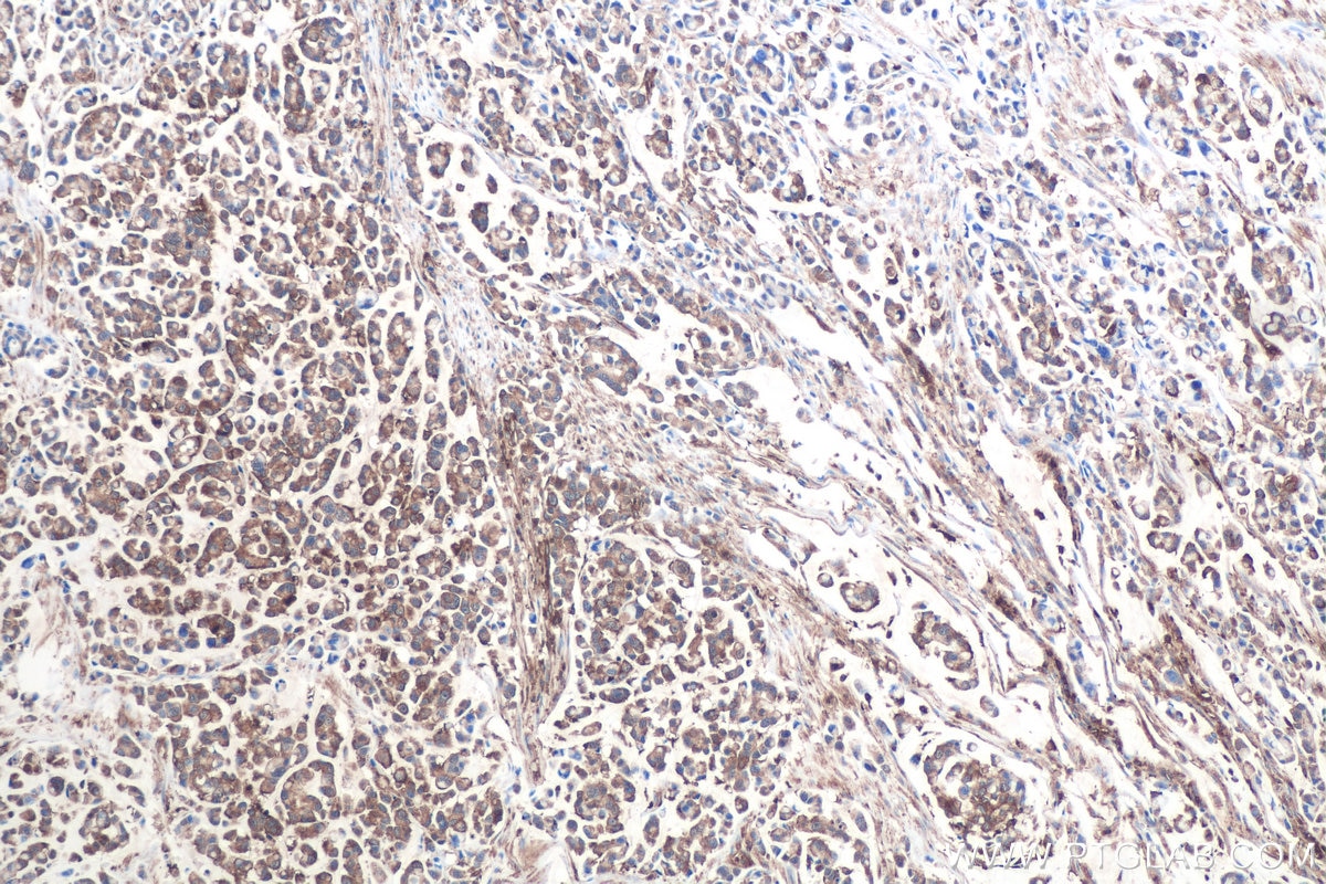 Immunohistochemistry (IHC) staining of human colon cancer tissue using CAP1 Monoclonal antibody (68207-1-Ig)