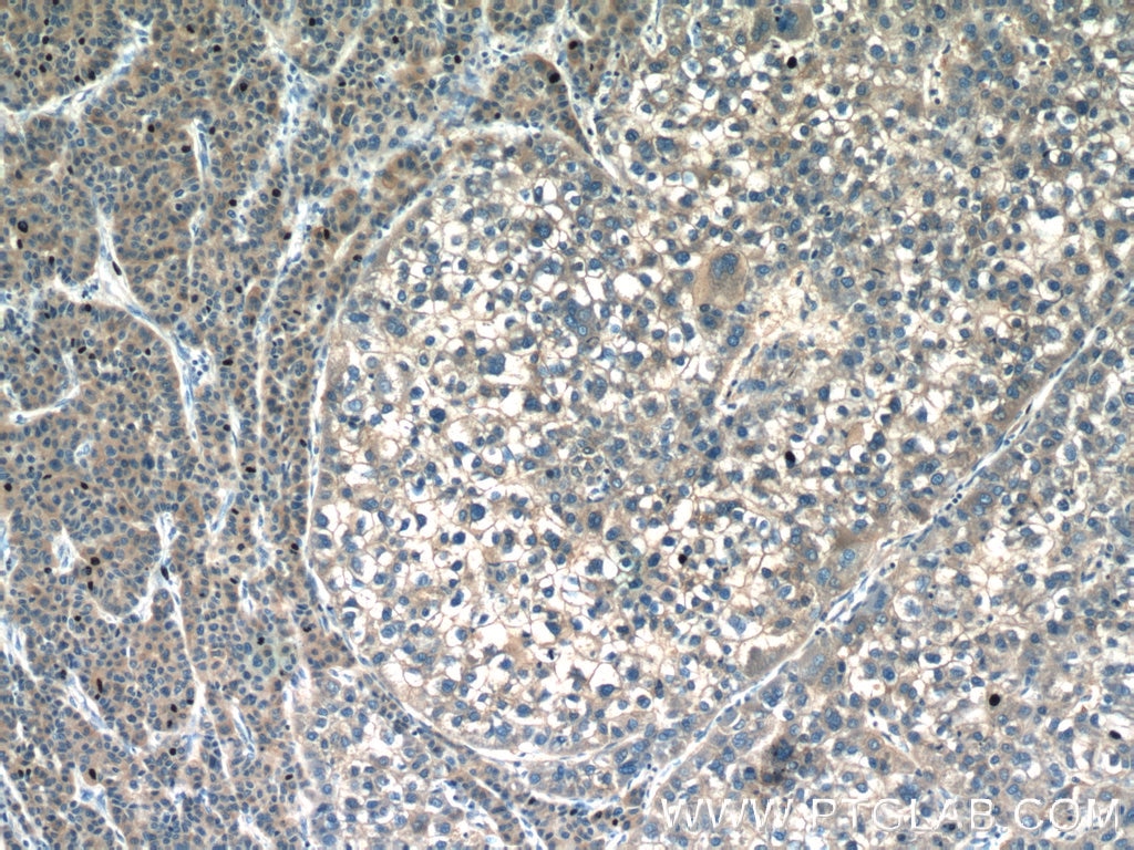 Immunohistochemistry (IHC) staining of human liver cancer tissue using CAP2 Polyclonal antibody (15865-1-AP)