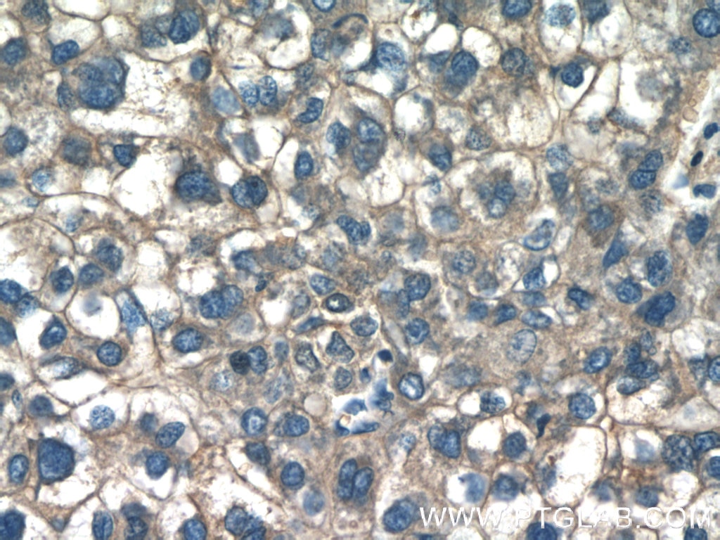 IHC staining of human liver cancer using 15865-1-AP