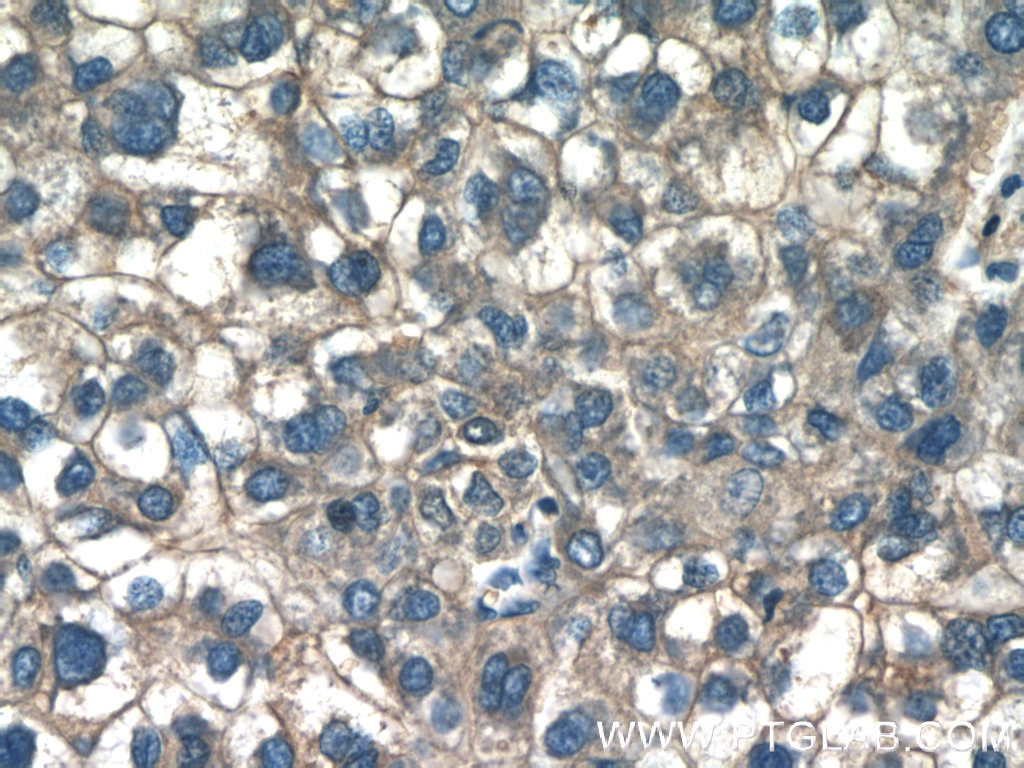 Immunohistochemistry (IHC) staining of human liver cancer tissue using CAP2 Polyclonal antibody (15865-1-AP)