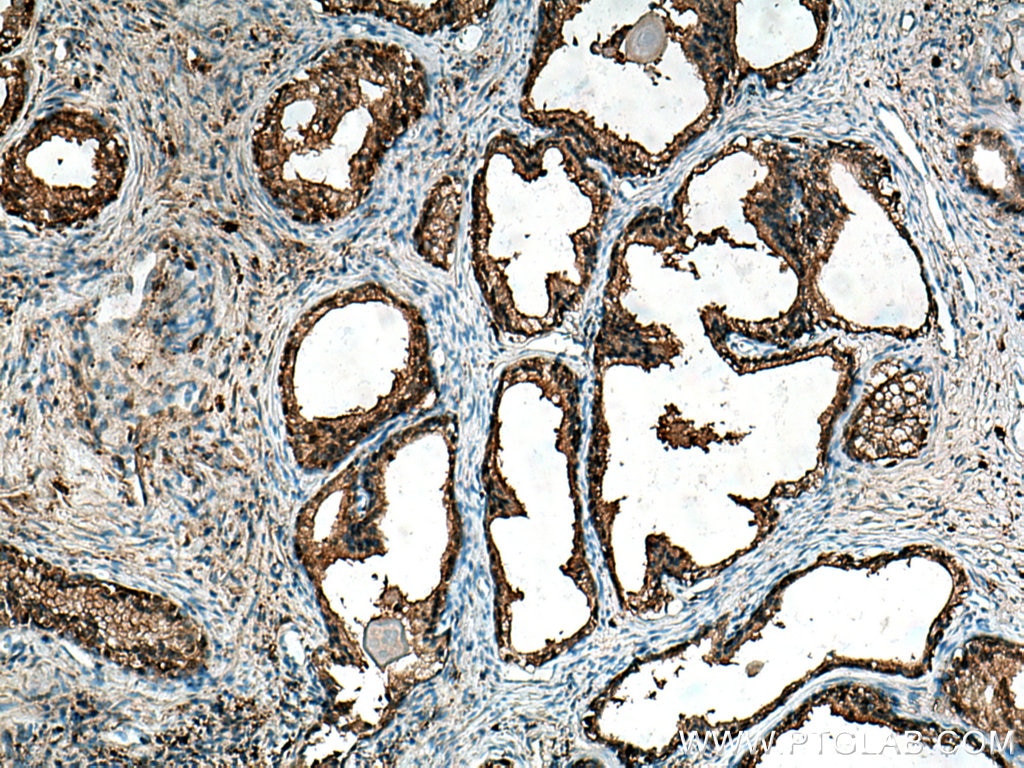 Immunohistochemistry (IHC) staining of human prostate cancer tissue using CAPG Polyclonal antibody (10194-1-AP)