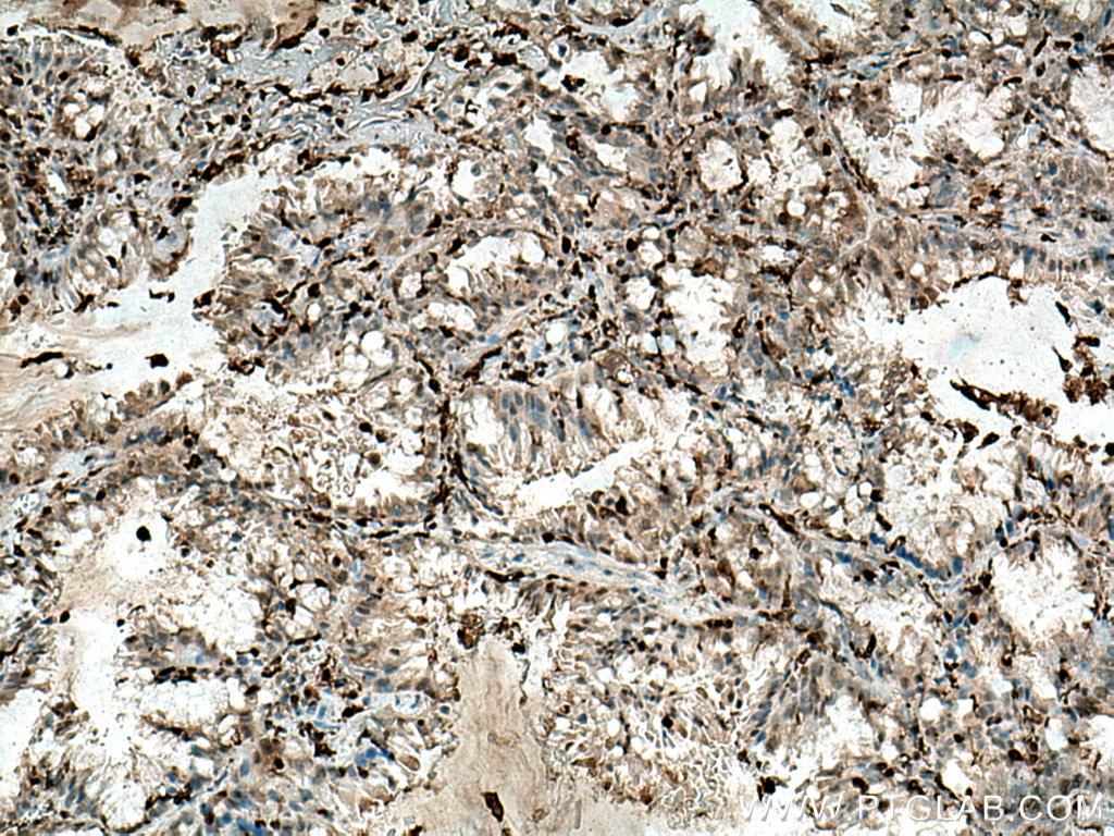 IHC staining of human lung cancer using 10194-1-AP