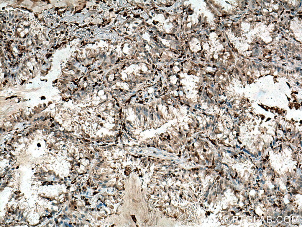 Immunohistochemistry (IHC) staining of human lung cancer tissue using CAPG Polyclonal antibody (10194-1-AP)