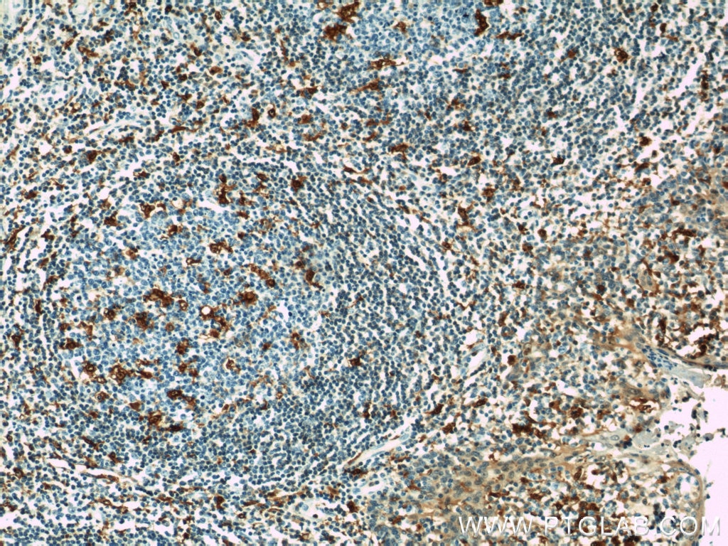Immunohistochemistry (IHC) staining of human tonsillitis tissue using CAPG Polyclonal antibody (10194-1-AP)