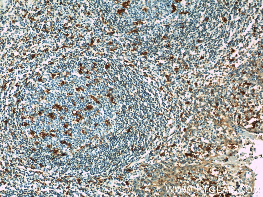 IHC staining of human tonsillitis using 10194-1-AP