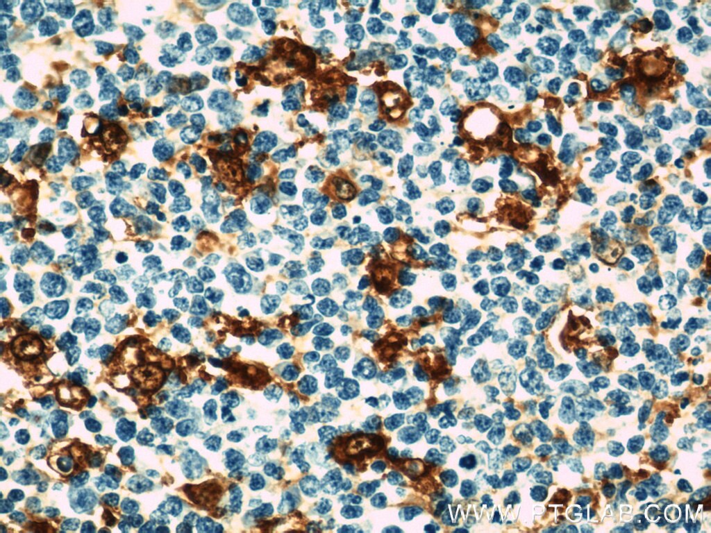 Immunohistochemistry (IHC) staining of human tonsillitis tissue using CAPG Polyclonal antibody (10194-1-AP)